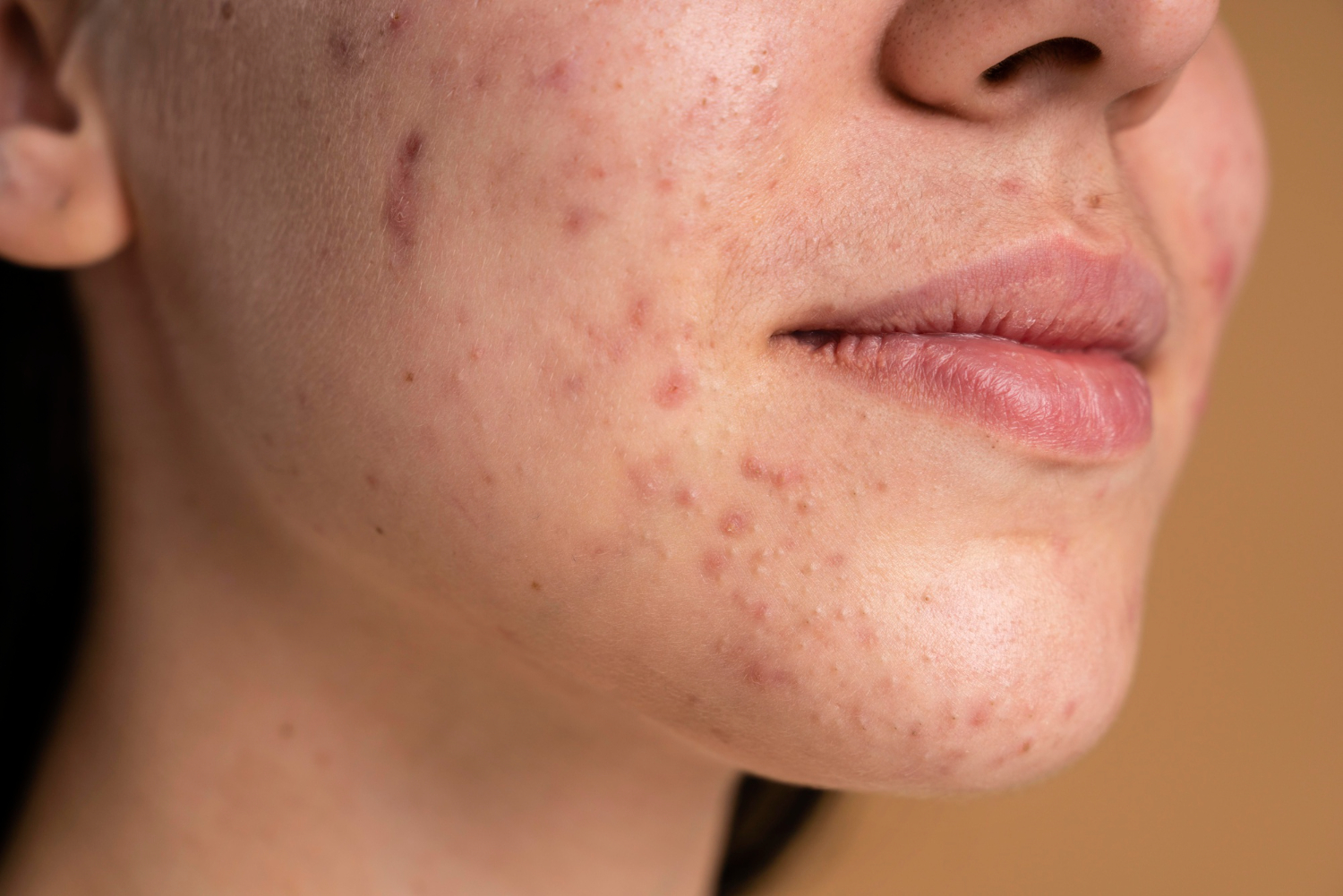 pimple scar treatment