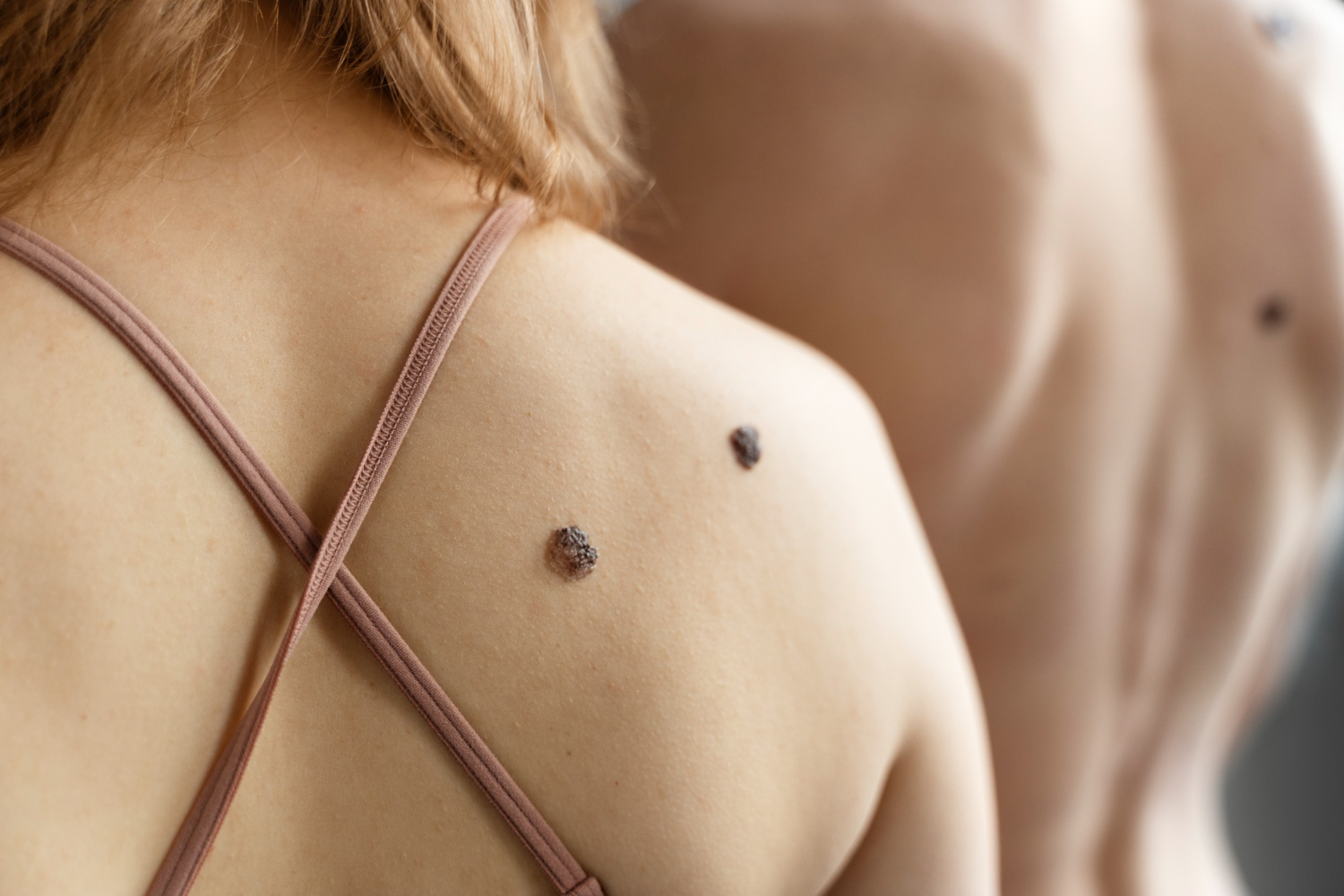 Skin tag removal treatment in hyderabad